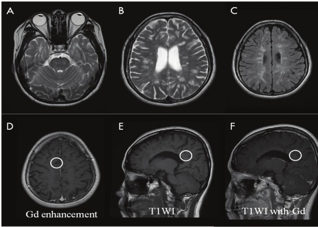 THE WINDOW OF MULTIPLE SCLEROSIS 그림 1. 초기뇌 MRI.