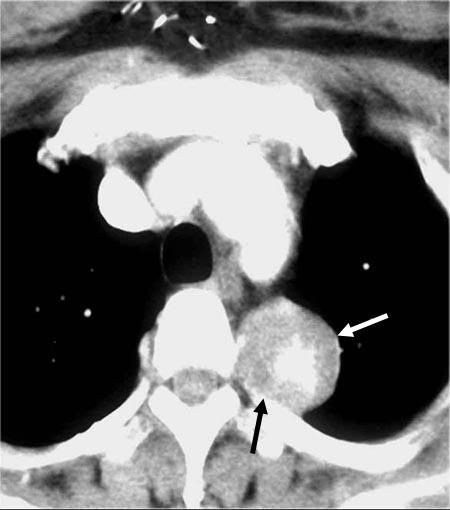 The rib erosion adjacent to the lesion suggests its extrapleural origin (black arrow on ). 명백한것으로구별된다. 흉막외병변은역시공기로둘러싸인경계부분이칼로그은것처럼명백하면서흉벽과의경계가둔각을이룬다.