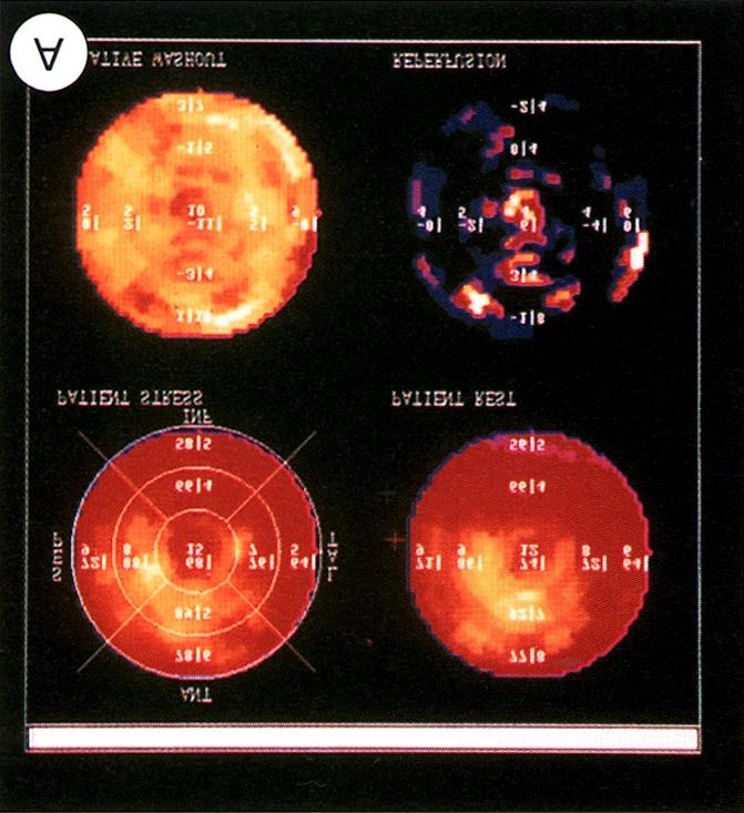 환자를 대상으로 분할용량의 탈륨-디피리다몰 평면 신 Fig. 2. Dipyridamole stress thallium SPECT imaging with abnormal thallium washout in patient with hypertrophic cardiomyopathy. The polar map (Fig.
