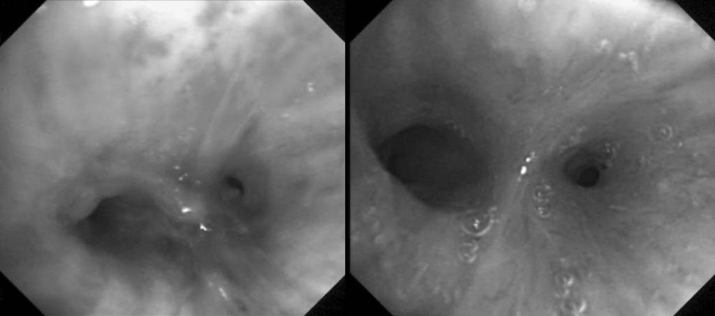 Photodynamic Therapy Figure 4. Double primary lung cancer at right upper lobe and lower lobe.