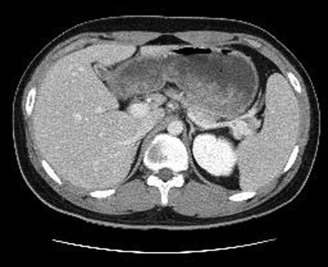 - The Korean Journal of Medicine : Vol. 74, No. 3, 2008 - A B Figure 1. (A) Abdomen CT shows hepatosplenomegaly, but no dilatation in the hepatobilliary tract.