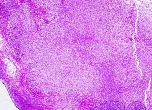 김진만 : 림프절의중등도및대세포림프종의세침흡인세포소견 81 Fig. 2. Follicular lymphoma, grade 3.