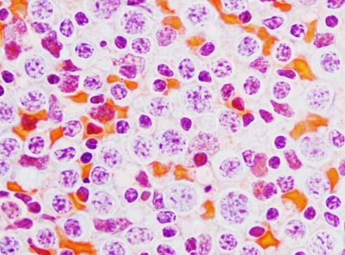 () Centroblastic type shows predominantly large cells with round vesicular nuclei and scattered small lymphoctes.