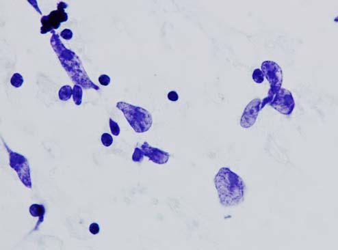 (Papanicolaou) 뚜렷한핵소체를볼수있다 (Fig. 3). 3 면역모구성림프종은한쪽으로편재된핵과뚜렷한핵소체를보이는면역모세포로구성되고세포밀도가높다.