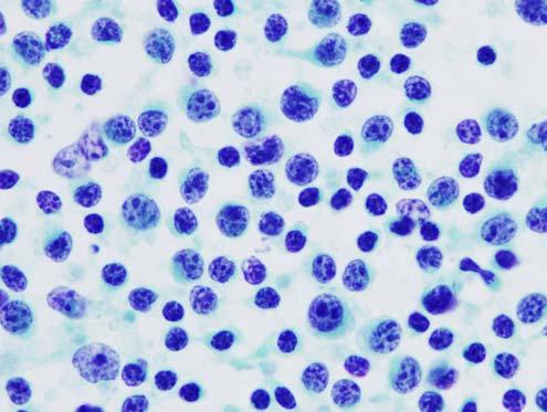 세포림프종, 코형 (Extranodal NK/T cell lymphoma, nasal-type) 균상식육종 / 세자리증후군 (Mycosis fungoides, Sezary syndrome) 혈관면역모구 T 세포림프종 (ngioimmunoblastic T cell lymphoma) 말초 T 세포림프종, 비특이형 (Peripheral T-cell