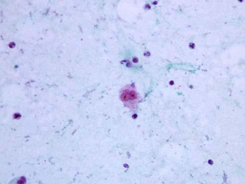 84 대한세포병리학회지 / 제 17 권 / 제 2 호 / 2006 Fig. 6. naplastic large cell lymphoma.
