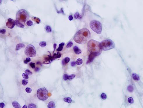 김진만 : 림프절의중등도및대세포림프종의세침흡인세포소견 85 Fig. 8. Metastatic nasopharyngeal carcinoma and malignant melanoma.