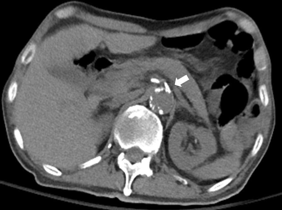 Yun Sun Choi, et al: Ischemic Gastritis