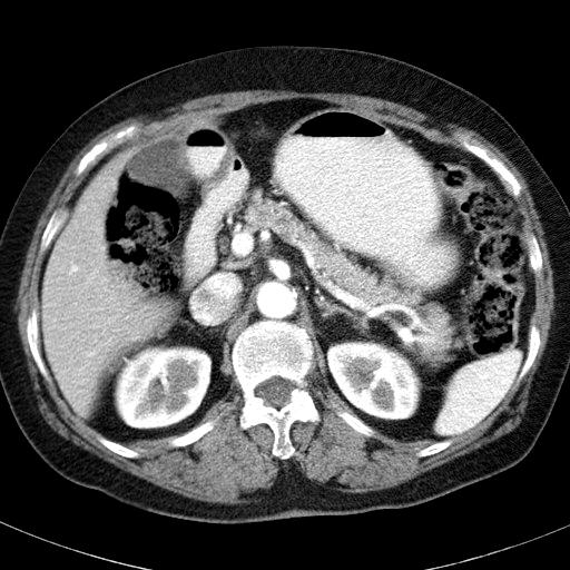 - Hyoung Jin Chang, et al. Insulin autoimmune syndrome related to α-lipoic acid - Figure 1. Abdominal computed tomography shows no evidence of a tumor in the pancreas. Figure 2.
