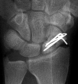 (D, E) There are multiple Kirschner wires used for internal fixation of scaphoid in immediately