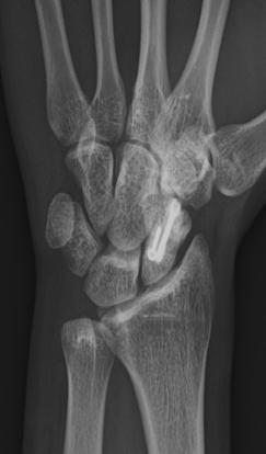 Plain radiographs after the 3rd  Scaphoid nonunion was treated