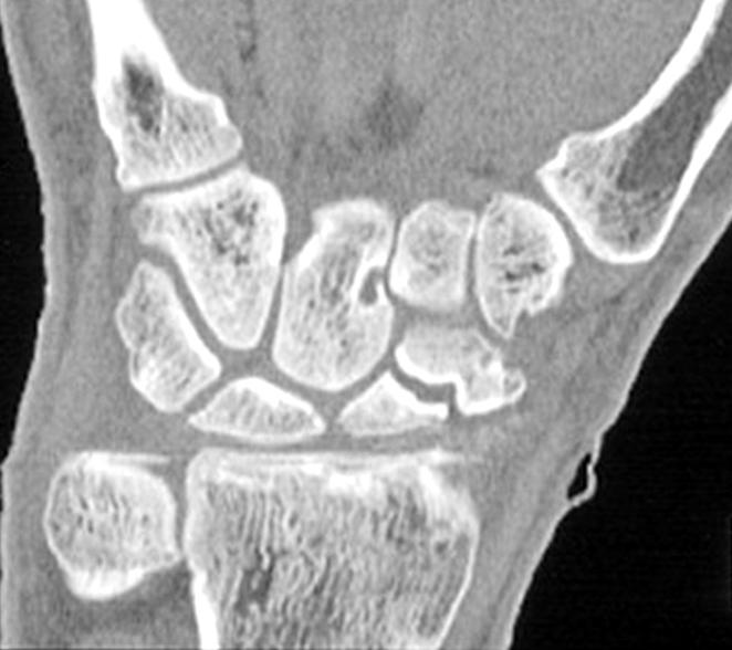 (B) Preoperative CT show sclerotic change & comminution of fracture site.