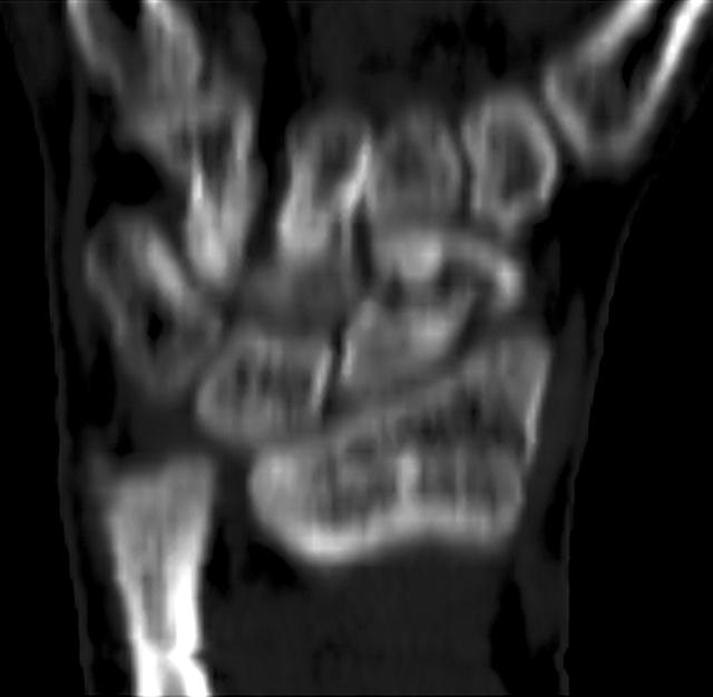 radiograph & CT. (C, D) Postoperative radiograph show complete union 12 weeks after surgery. 3.