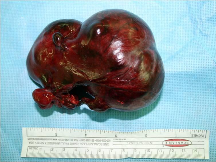 대한산부회지제 53 권제 11 호, 2010 A Fig. 3. This photograph is gross and microscopic finding of hydrosalpinx after surgical excision. (A) Gross photograph shows edematous and congested mass.