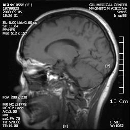 Fig. 2. Brain MRI, checked at September, 2003. This picture show mild atrophy in bilateral cortices. 계산장애를보여부분적인 Gerstman 증후군을관찰할수있었다.