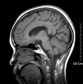 A B C Fig. 3. Brain MRI, checked at January, 2007.
