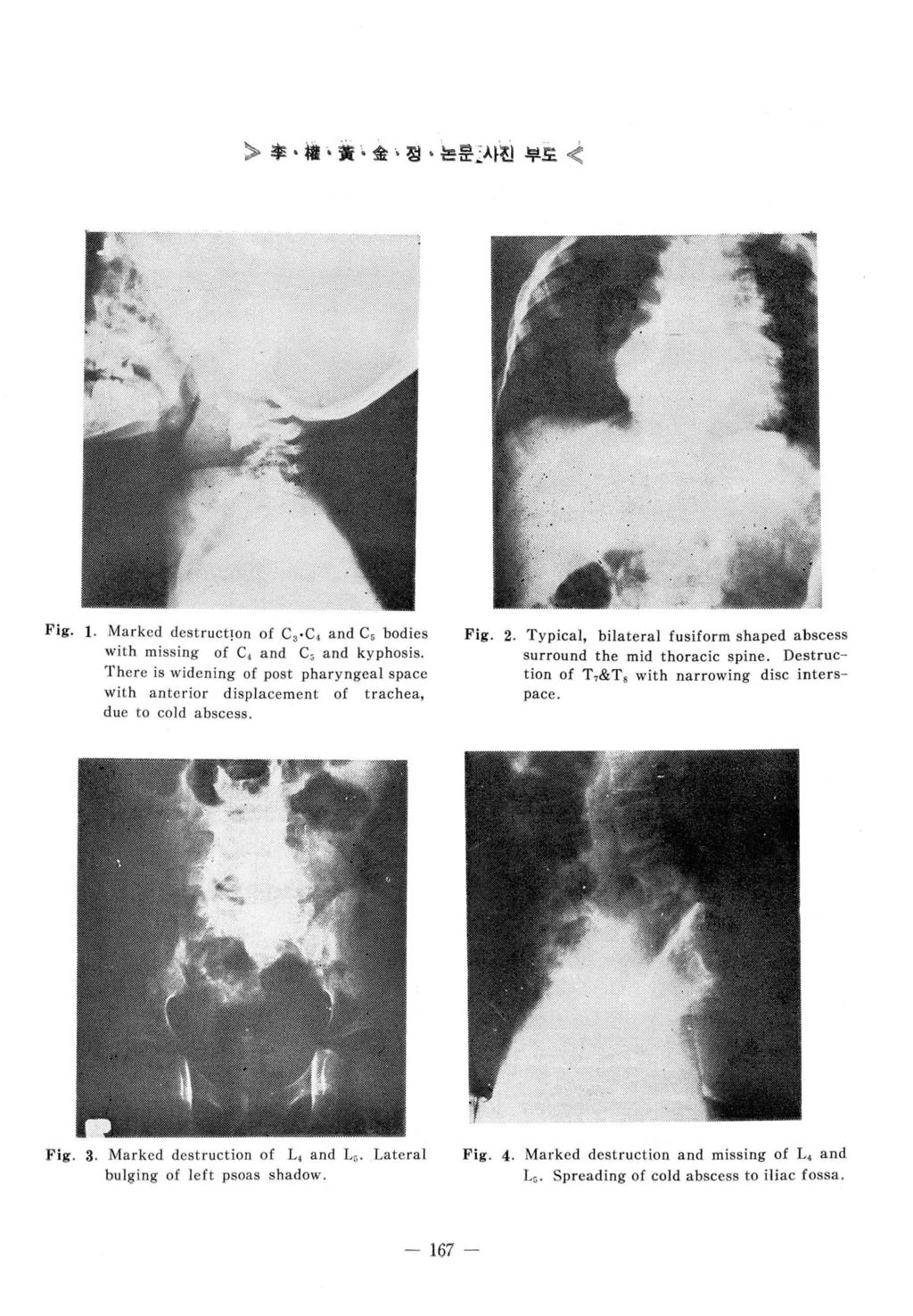 > 후 樓 훌 金 청 논쁨 ; 사원부효 t Fig. 1. Marked destruct!on of C 3.C, and C5 bodies Fig. 2. Typical, bilateral fusiform shaped abscess with missi ng of C and C, and kyphosis. surround the mid thoracic spine.