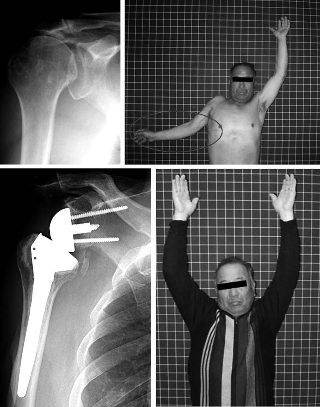 김명선 : 광범위회전근개파열에서관절성형술 A B C D Fig. 6. Anteroposterior (A) Radiograph of 71-year-old male patient with a pseudoparalytic painful shoulder (B) Show cuff tear arthropathy.