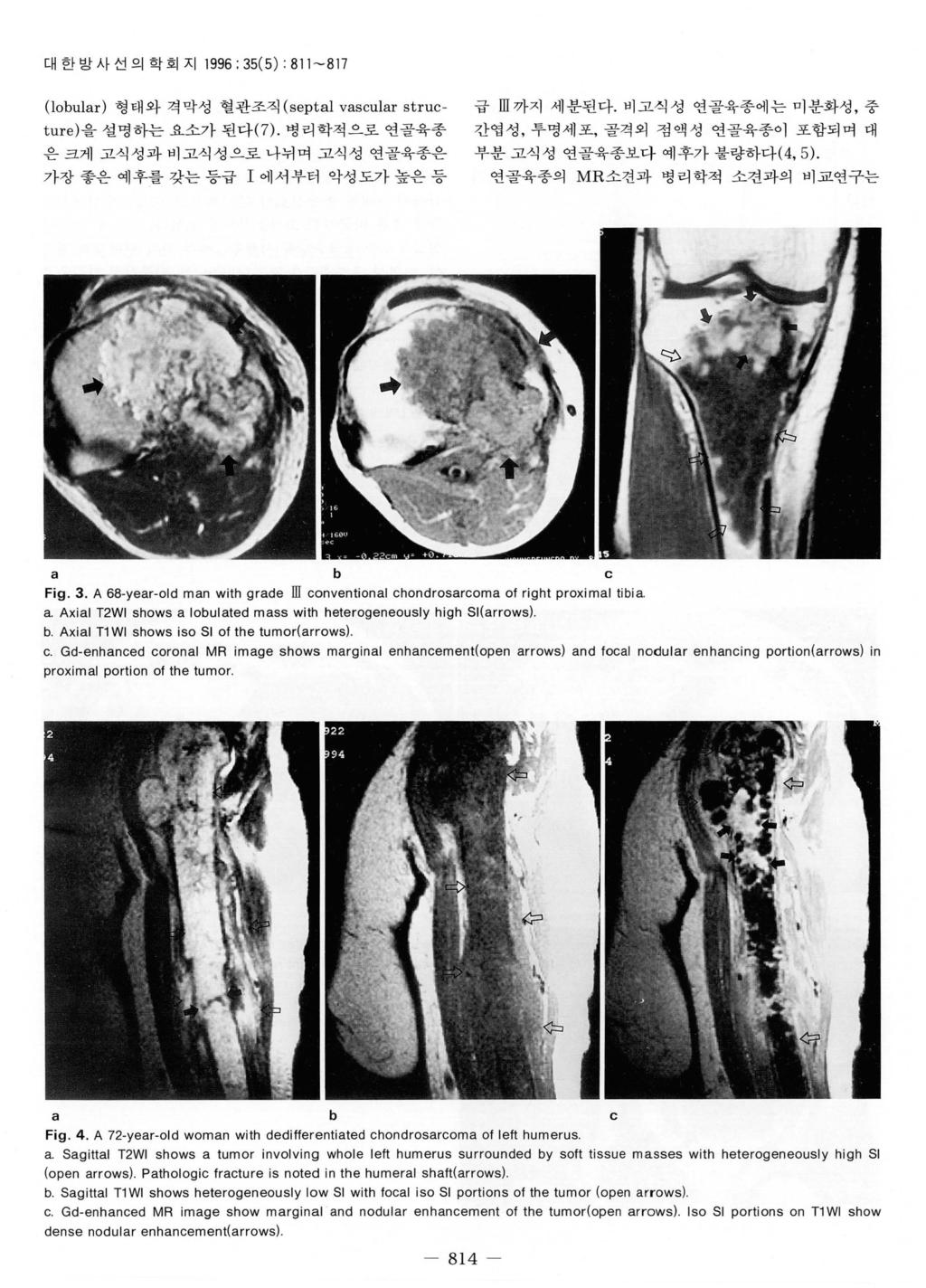 대한방사선의학회지 1996 : 35( 5) : 811 ~ 817 (lobular) 형태와격막성혈관조직 (septal vascular structure) 을설명하는요소가된다 (7). 병리학적으로연골육종은크게고식성과비고식성으로나뉘며고식성연골육종은가장좋은예후를갖는등급 I 에서부터악성도가높은등 급 m 까지세분된다.