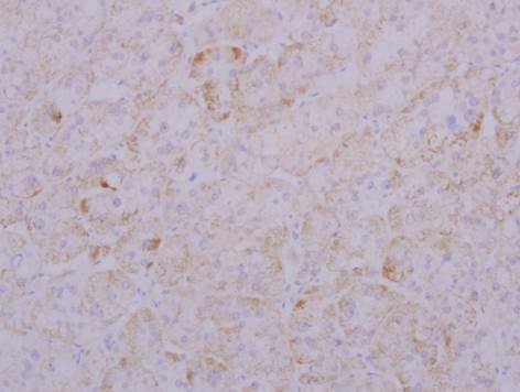 으로이루어져부신샘종에합당하였고 (Fig. 2A), 면역조직화학염색결과 CYP11B2 양성, CYP11B1 음성소견이었다 (Fig. 2B and 2C).