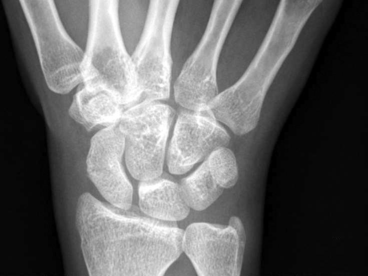 7 비전위성 주상골 골절의 비수술적 치료 ig.. (A, B) Plain radiographs of -year-old female patient showed fracture at the waist of scaphoid.