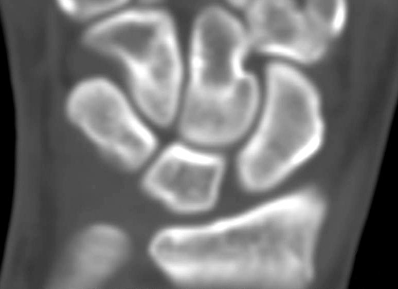 7 이상욱ㆍ송석환ㆍ이승구 외 인 ig.. (A, B) Plain radiograph and computed tomogram showed scaphoid fracture, Herbert type B.