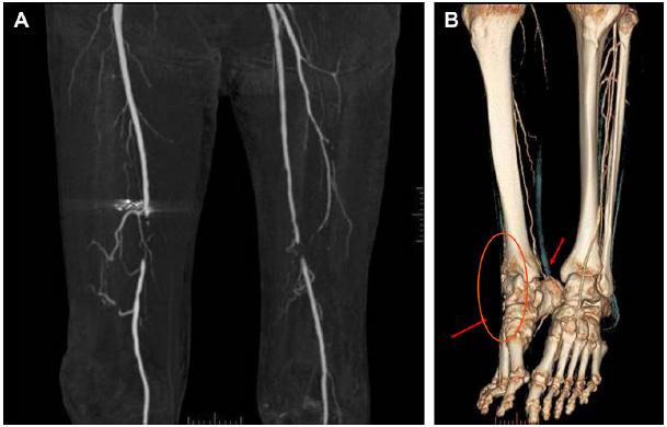 이재환외 1 인. DM foot ulcer management Figure 3. (A) The descending branch of the circumflex femoral artery is the main collateral of the distal perfusion of the limb.