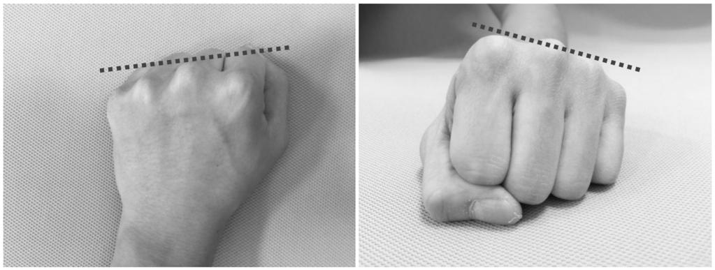 2015 한국의지 보조기학회춘계학술대회 여제 2, 3 중수골의감소된운동성때문이다. 이러한두가지경사개념은보조기제작시포함되어야한다. Fig. 3. Dual obliquity of hand.