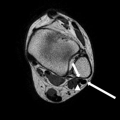 Its most common insertion site is the retrotrochlear eminence of calcaneus (curved arrow). 로두개의분리된건조직이확인되었으며, 단비골근뭉치가발목관절면까지정상보다하방으로위치하는소견이관찰되었다 (Fig. 2A, B).