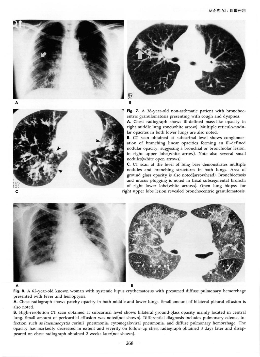 서준범오 1: 며 혈관염 ~ Fig. 7. 38-year-old non-asthmatic patient with bronchocentric granulomatosis presenting with cough and dyspnea.
