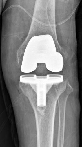 66 정철용 은일수 김진완외 2 인 Figure 5. Total knee arthroplasty was performed at 6 months after the septic knee arthritis had been cured. 의재발소견은관찰되지않으며, 혈액검사도정상으로굴곡구축 5도, 후속굴곡 100도의운동범위를보이고있다.