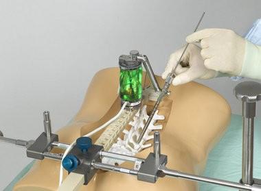 newsid=20150316000 010 네비게이션시스템으로각각모낭및모발의방향을자동으로체크하여비절개방식으로모발을이식함으로써수술시간을단축해주는모발이식용수술로봇 3