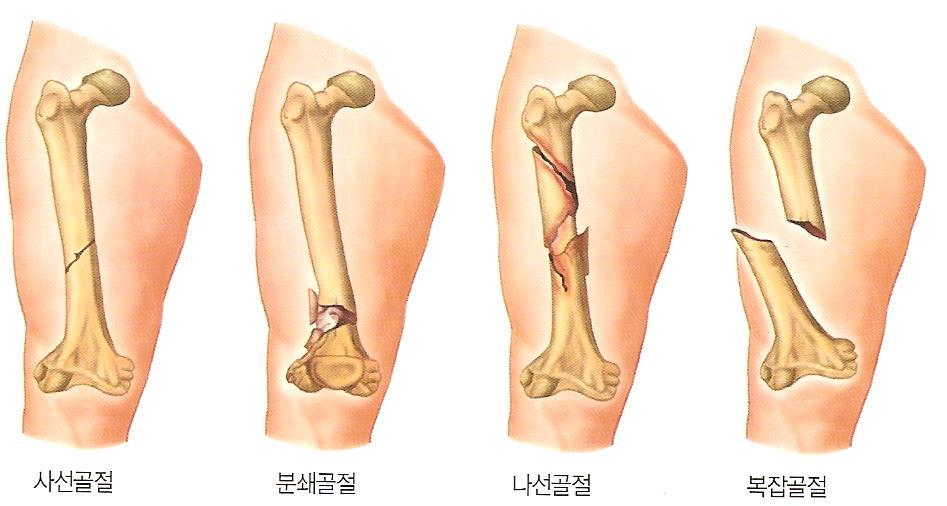2. 근육골격계손상의종류 1) 골절 (1) 정의 : 뼈가부러지거나파괴된상태 (2) 원인 :- 외부의직접, 간접적인힘에의해서.
