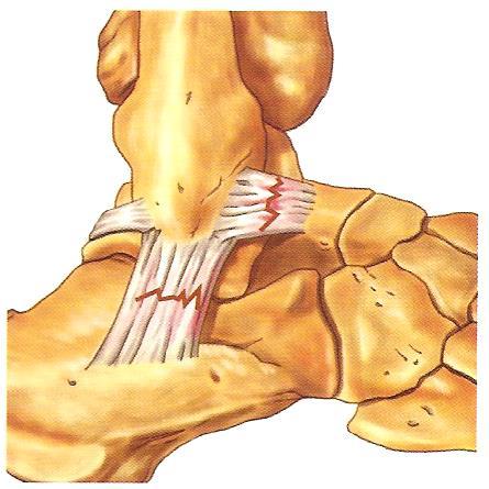 3) 염좌 (1) 정의 : 인대등관절조직이일부또는전체적으로파열된상태 (2) 원인관절을형성하는뼈가정상운동범위를벗어나는심한부하를받았을때발생.