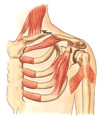 5. 신체부위별골절처치 1) 빗장뼈 ( 쇄골 ) 골절 (1) 증상 - 골절의일반적인증상이나타난다.