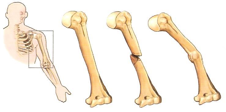 5. 신체부위별골절처치 2) 윗팔뼈 ( 상완골 ) 골절 (1) 증상 -