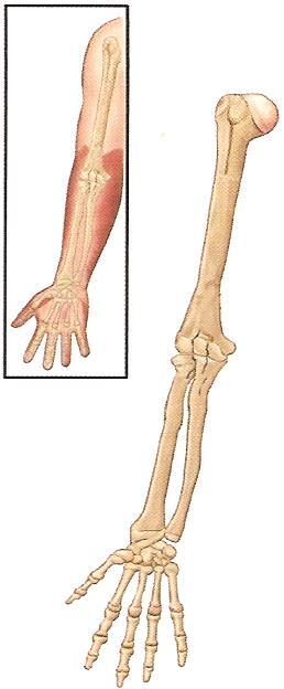 5. 신체부위별골절처치 3) 팔꿈치뼈 ( 주관절 ) 골절 (1) 원인 - 팔을구부리고넘어질때생기며