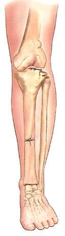 5. 신체부위별골절처치 7) 정강뼈 ( 하퇴 ) 골절 (1) 증상 - 무릎과발목사이에서뼈가 1 개혹은 2 개가부러진것 - 2