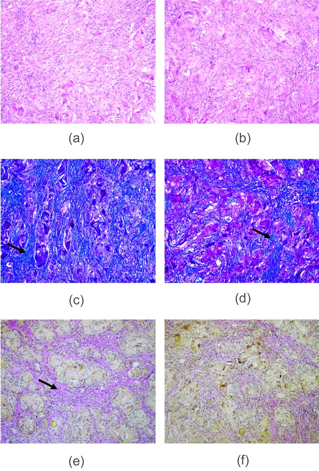 Histlgical crsssectins f βchitin (a, c, and e) and αchitsan (b, d, and f) scafflds after 15 days. (ab) H&E stain ( 200), (cd) Massn's trichrme stain ( 200), and (ef) van Giesn's stain ( 200).