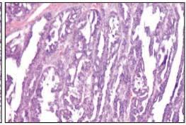 (B) Papillary growth pattern shows fibrovascular cores within the papillae in serous cystadenocarcinma.
