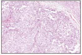 (D) Nuclear grade 1 exhibits small, regular, and lack prominent nucleoli, marked hyperchromasia or bizarre form in serous cystadenocarcinoma.