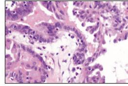 (F) Nuclear grade 3 shows marked variation of nuclei, giant nucleoli, and several large bizarre nuclei in endometrioid carcinoma. Table 1.