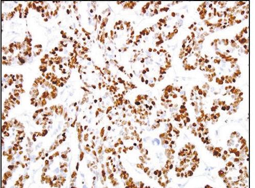 (C) p53 overexpression (>50%) is demonstrated in case of endometrioid carcinoma. (D) The increased Ki-67 positive cells (>50%) in case of endometrioid carcinoma is noted.
