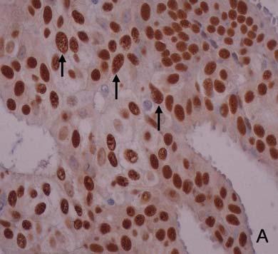 Fig. 1. Immunohistochemical staining for ER and PR in breast ductal carcinoma(abc, 400). A ; Showing ER positive in nuclei of cancer cells(arrow).