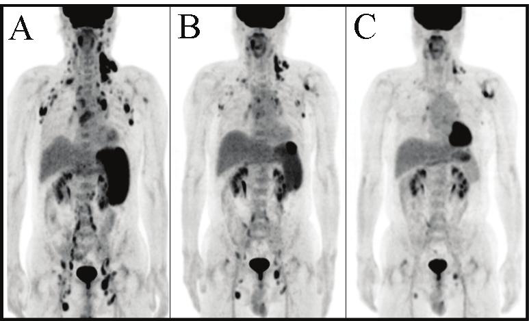 김경민외. 방사선내부흡수선량의의학적적용 Figure 1. Effect of repetitive RIT with 131 I labeled rituximab. (A) baseline image before the first RIT, (2) result of the first RIT, and (C) result of the second RIT.