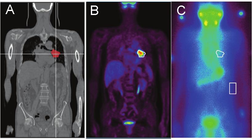 김경민외. 방사선내부흡수선량의의학적적용 Figure 4. The use of multi-modality images to delineate the disease region of interest.