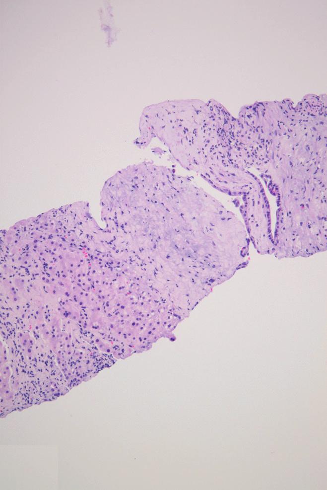 Intrahepatic Sarcomatoid Cholangiocarcinoma Mimicking Liver Abscess A B C Fig. 2.