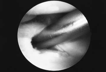 수근관절류마토이드관절염의관절경적활액막절제술 635 Lunate Capitate Scaphoid Ulnar head Fig. 3. A motorized shaver was introduced through the perforated hole of the for resection of synovium of the distal radioulnar joint.
