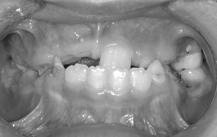 대한소아치과학회지 35(3) 2008 한다 7). 본증례는비정상적으로매복되고치근이순측으로만곡된상악우측중절치의초기치근발육단계에서외과적재위치를시행한증례로서 2년간정기검진한결과치아가정상적으로맹출하고치근이완성되어이를보고하는바이다. Ⅱ. 증례보고 7세여아가상악우측중절치의미맹출을주소로경희대학교소아치과에내원하였다.