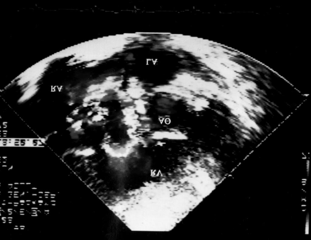 0/90 mmhg, 심박동은 분당 Fig. 1. preoperative chest P shows cardiomegaly. postoperative chest P shows normalized heart size. Fig. 2.